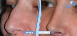 Rinoplastia en Madrid. Clínica Ruber