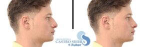 Postoperatorio de una rinoplastia. Clínica Ruber Madrid. Estética Castro Sierra